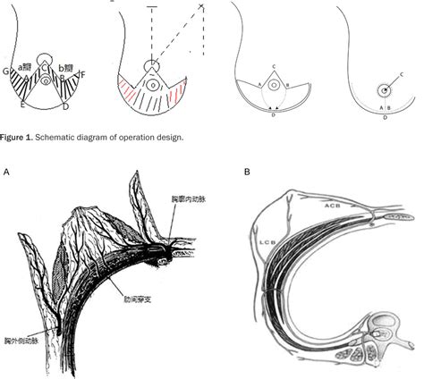 Figure 1 From The Combination Of Inferior Pedicle Method And Dermal