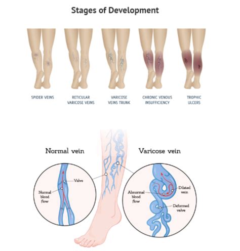 Venous Insufficiency Varicose Veins Vegas Vascular Specialists