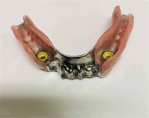Implant Supported Partial Dentures