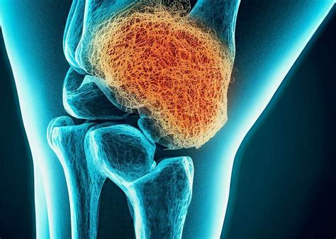 Mucoid Degeneration ACL Symptoms, Causes, Treatment