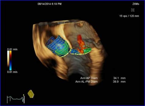 3d Ultrasound Of The Heart