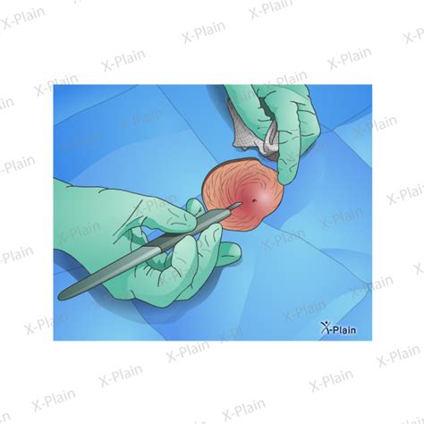 Cyst Removal Surgery