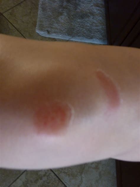 Pinney Family: Skinned Knees and Fat Ankles