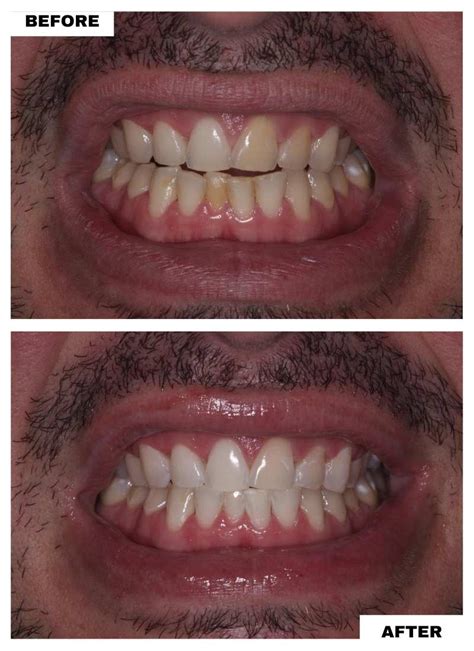 Cosmetic Dentistry Before and After: Invisalign, Zoom, Veneers - South ...