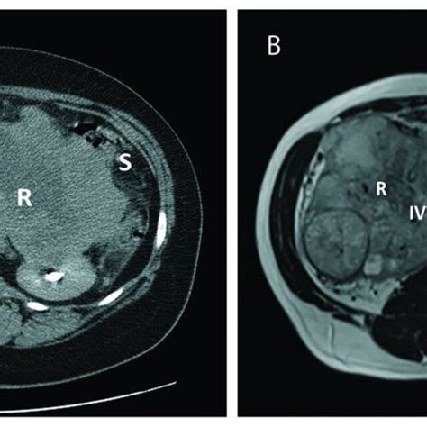 Computed Tomography Ct And Magnetic Resonance Imaging Mri Of Two