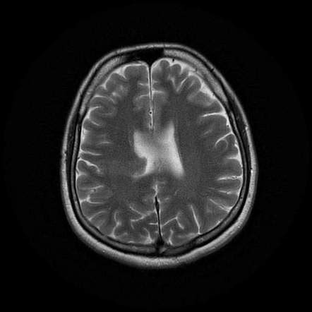 Closed Lip Schizenchephaly Radiology Case Radiopaedia Org