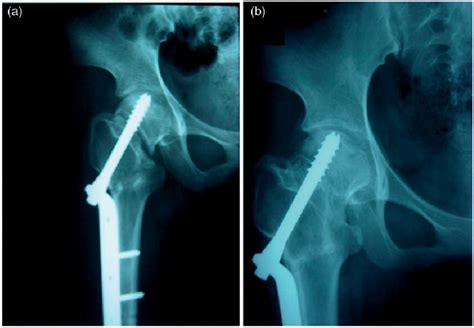 Figure 2 From Treatment Of Nonunion After Femoral Neck Fracture With