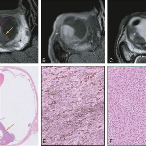 MR And Grossing Images Of A Uveal Melanoma With Extrascleral Extension