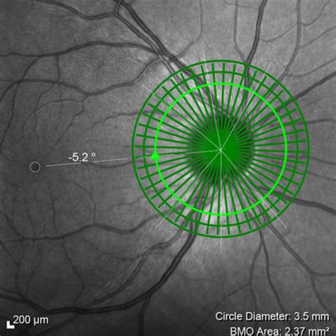 Heidelberg Spectralis Glaucoma Module Premium Edition Innova