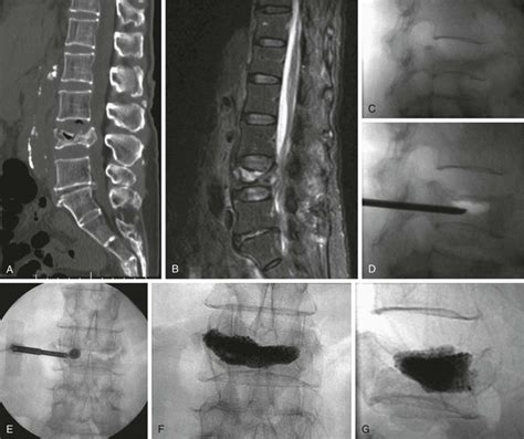 Vertebroplasty and Kyphoplasty | Radiology Key