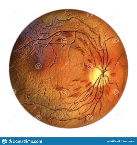 Diabetic Retinopathy Ophthalmoscopic Diagnosis Illustration Stock