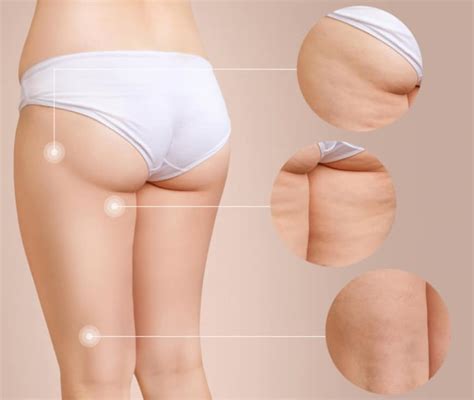 Cellulite E Ritenzione Idrica Quali Sono Le Differenze