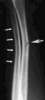 Splints Fractures Flashcards Quizlet