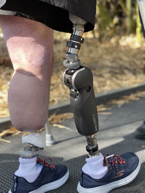 Prosthetic Leg Leg Prosthesis Apc Prosthetics