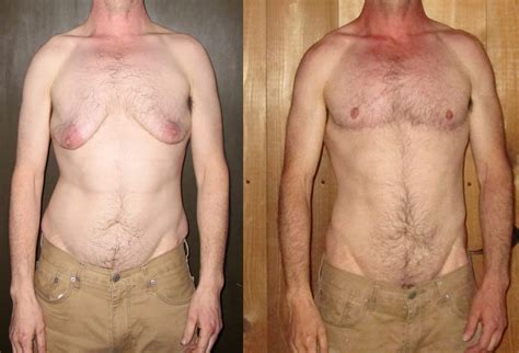 Ftm Gender Affirmation Top Surgery Before And After