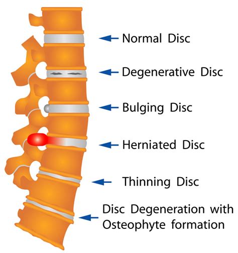 Treat A Herniated Disk With Chiropractic Care