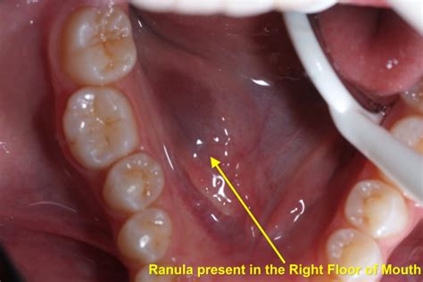 Ranulas Ranulæ And Their Treatment Exodontia