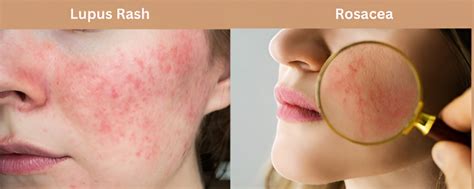 Lupus Rash Vs Rosacea Symptoms Causes And Treatment