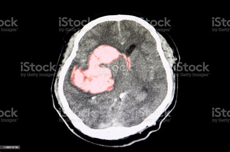 Tomografía Computarizada Del Cerebro Que Muestra Hemorragia