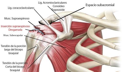 Tendinitis De Hombro O Supraespinoso Infiltraciones Fisioonline