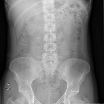 Normal Abdominal Radiograph Annotated X Ray Radiology Case