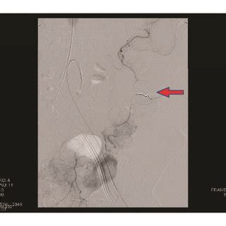 Super Selective Embolization A Before And B After Coil Deployment