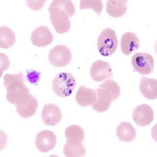 Malaria Smear Stain