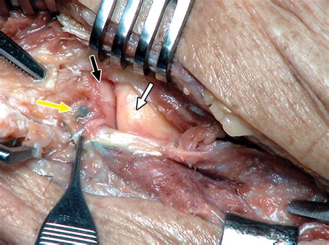 Sonography Of The Lateral Ulnar Collateral Ligament Of The Elbow Study