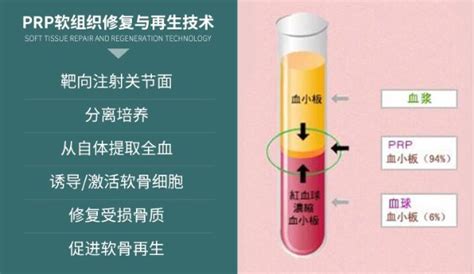 体育明星都在用的prp疗法—膝关节炎患者的新福音 壹读