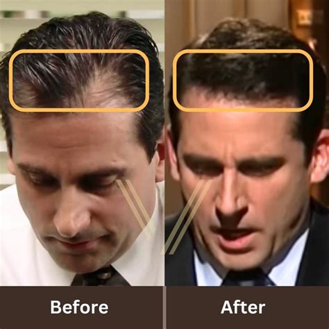 Steve Carell S Hair Transplant Before And After Transformation