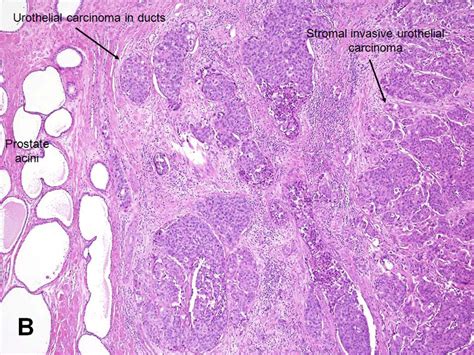 American Urological Association Urothelial Carcinoma Of The Prostate