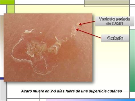 Escabiosis Dermatología