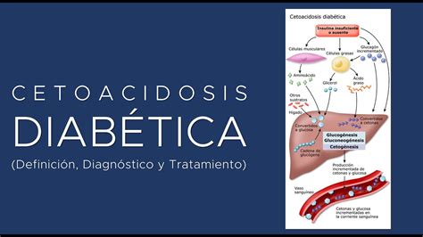 Cetoacidosis Diab Tica Definici N Fisiopatolog A Diagn Stico Y