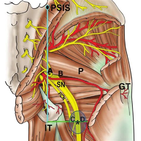 Surface Projection Of The Sciatic Nerve On A Patient Using Anatomical