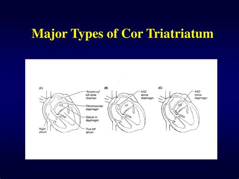 Ppt Cor Triatriatum Powerpoint Presentation Free Download Id645287