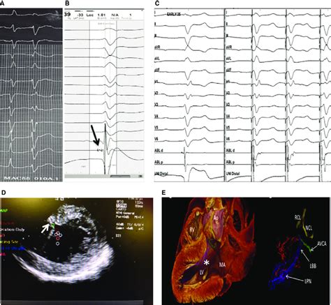 A Resting Lead Ecg Of Sinus Beat Followed By Pvc Note There Is No