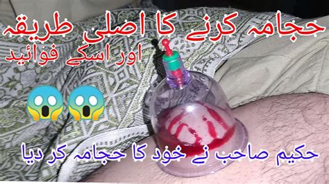 Wet Cupping Therapy Hijama For Skin Care Hijama Cupping Youtube