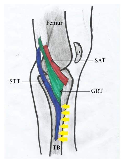 A Photograph And B Schematic Illustration Showing Painted Type I