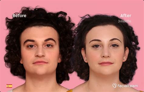 elizabeth    ffs surgery facialteam