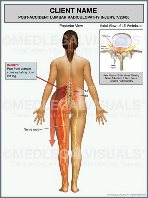 Sciati Longsun How To Get Doctor For Sciatica Treatment