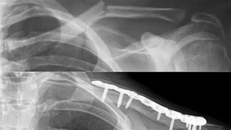 Fracture Clavicule Traitement Epaule Osteosynthese Plaque Epaule