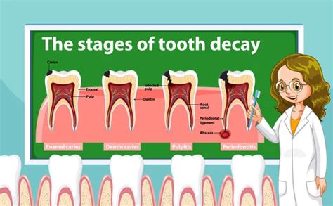 55 Stages of tooth decay Stock Illustrations | Depositphotos