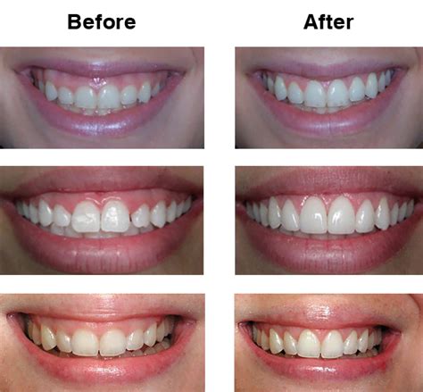 Gum Recontouring Professional Services At Starlight Dental Clinic