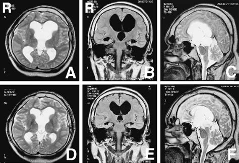 Figure 1 From Acquired Intraventricular Arachnoid Cyst Of The Third