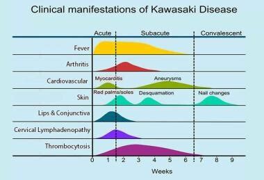 Kawasaki Disease Clinical Presentation: History, Physical Examination