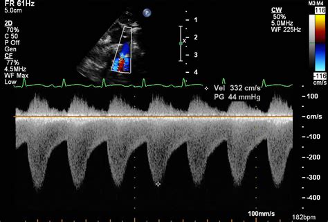 Suprasternal notch | Pediatric Echocardiography