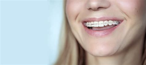 Ceramic Braces Adelaide - Clear Orthodontics - Orthodontic Smile Practice