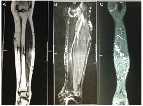 Scielo Brasil Intraosseous Anomalous Drainage A Rare Case Of