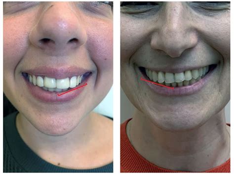 6 Signs of Bad Veneers: Veneers Gone Wrong | Bali Dental Voyage