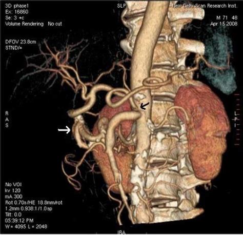 Celiac artery stenosis (black arrow) with tortuous pancreaticoduodenal... | Download Scientific ...